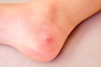 What Are Diabetic Blisters?